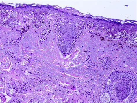 lentigo maligna melanoma pathology outlines